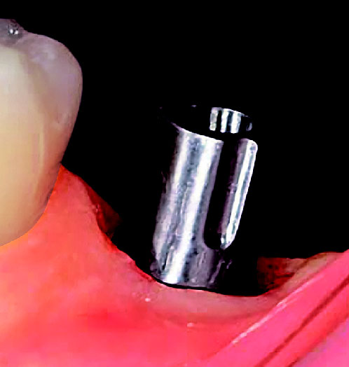 GC ZIRCONIA HIGHLIGHTS