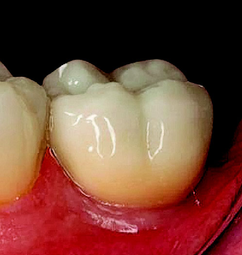 GC ZIRCONIA HIGHLIGHTS